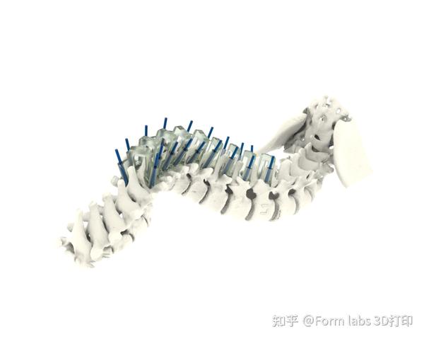 3D打印手术导板在三甲医院应用实例:高效、精确匹配不同手术类型 - 知乎