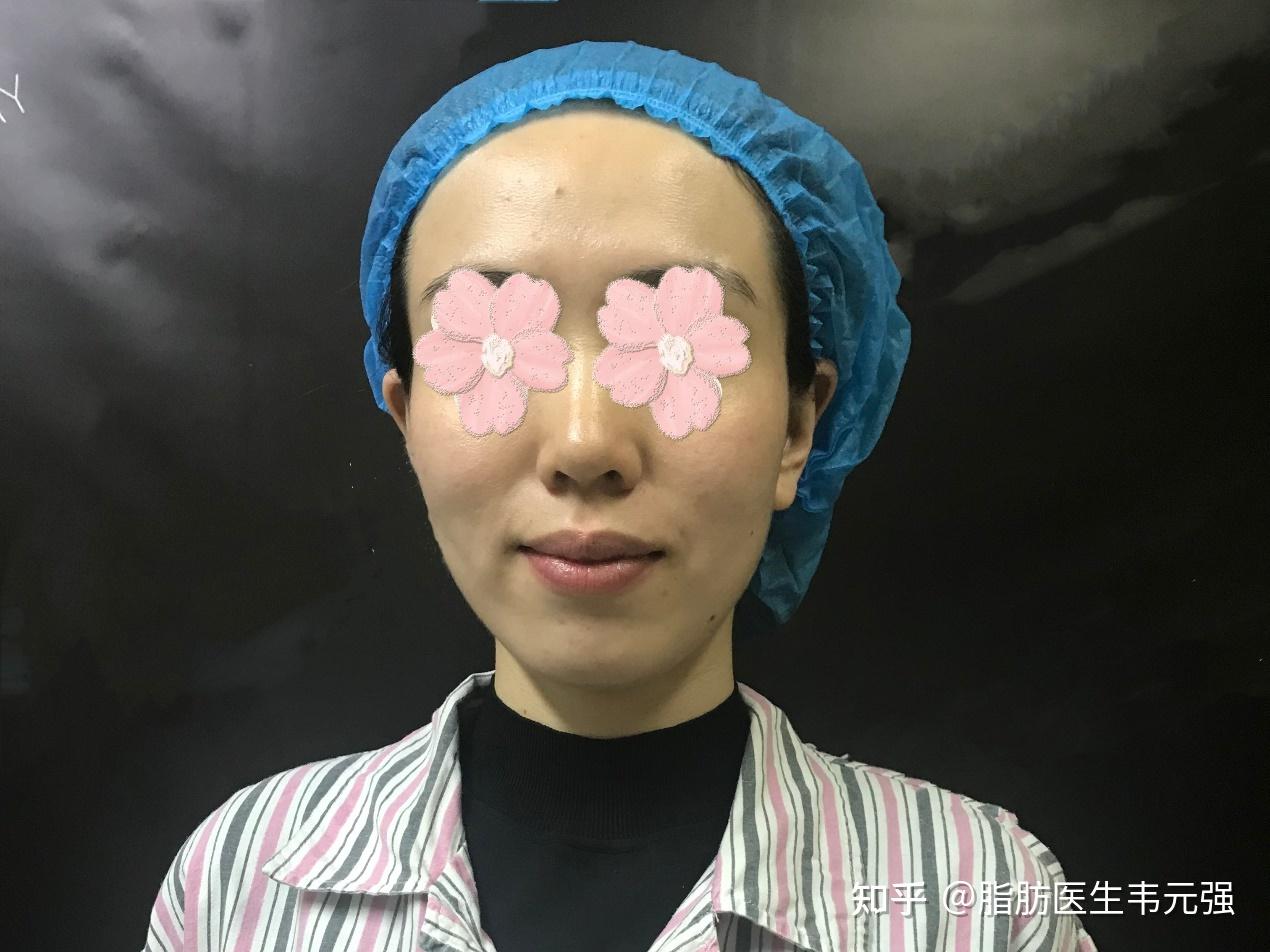 南京哪家医院做面部脂肪填充最好最自然？ - 知乎