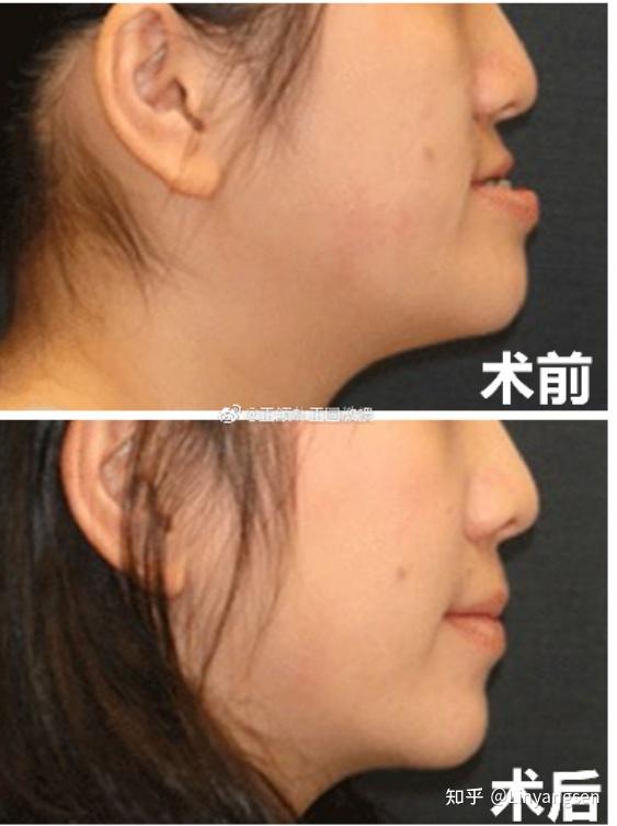 颏成型手术和正颌手术哪个风险大