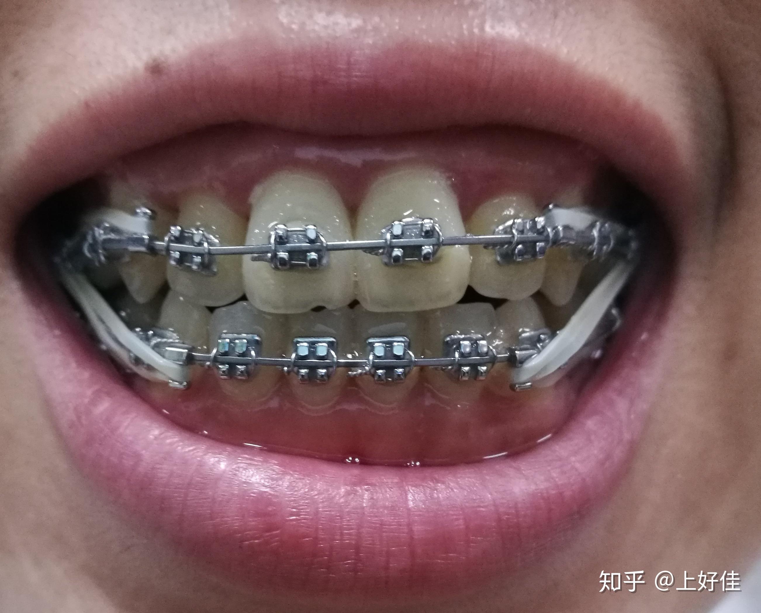 全同步带状弓整牙日记(每周一更,完更)20年6月-24年3月