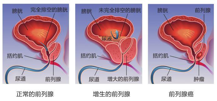 什麼是前列腺增生伴鈣化倆種疾病一起來嚴重嗎