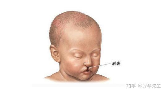 拒绝唇腭裂孕早期的预防很重要