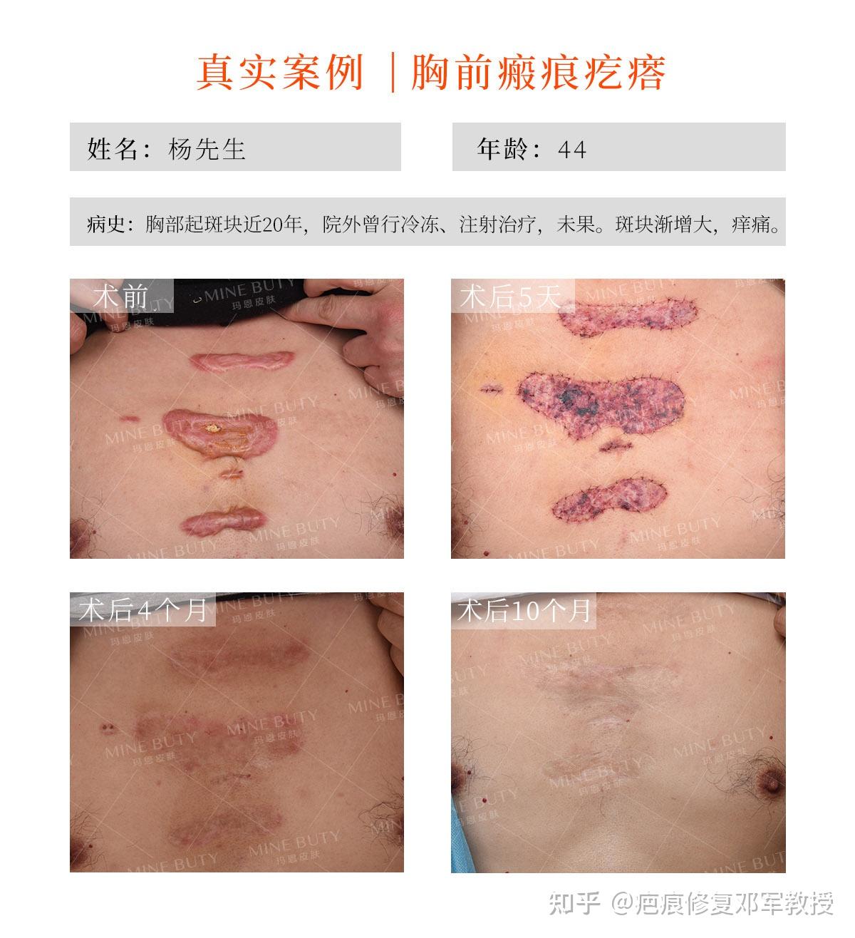 大面积植皮能恢复到和正常皮肤差不多吗？ - 知乎