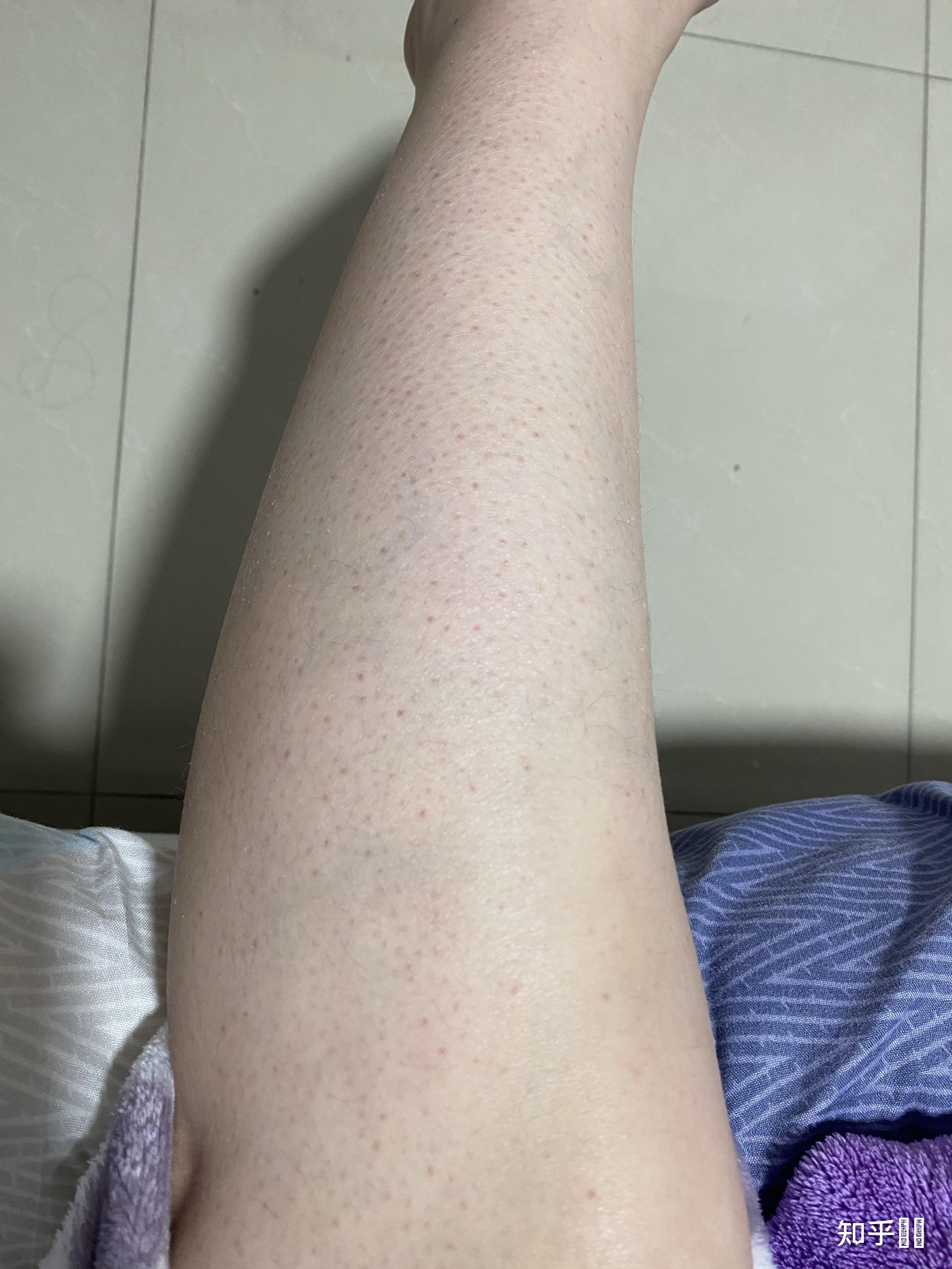 年纪轻轻23岁手上皮肤就很干有很多皱纹像老年人干瘪的手怎么办呀