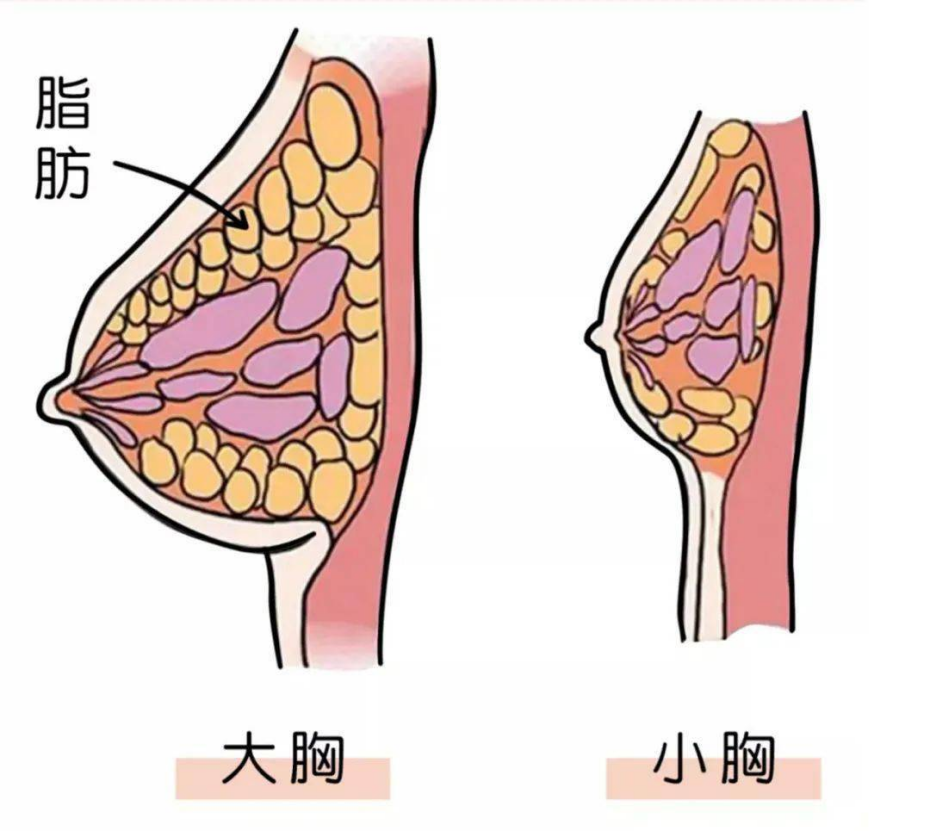 自体脂肪丰胸手感真实吗?