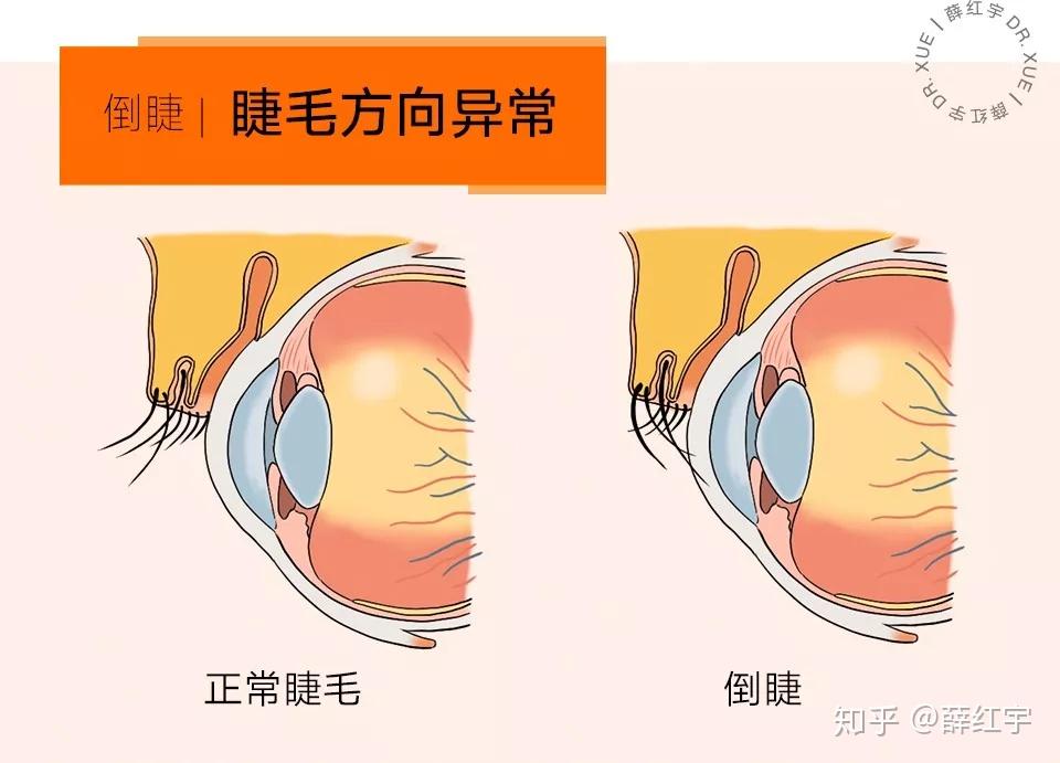 倒睫睫毛下压睫毛相关问题合集