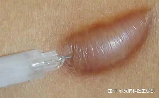 对封闭针这种产品不是特别了解,也不明白疤痕针会带来什么严重的副