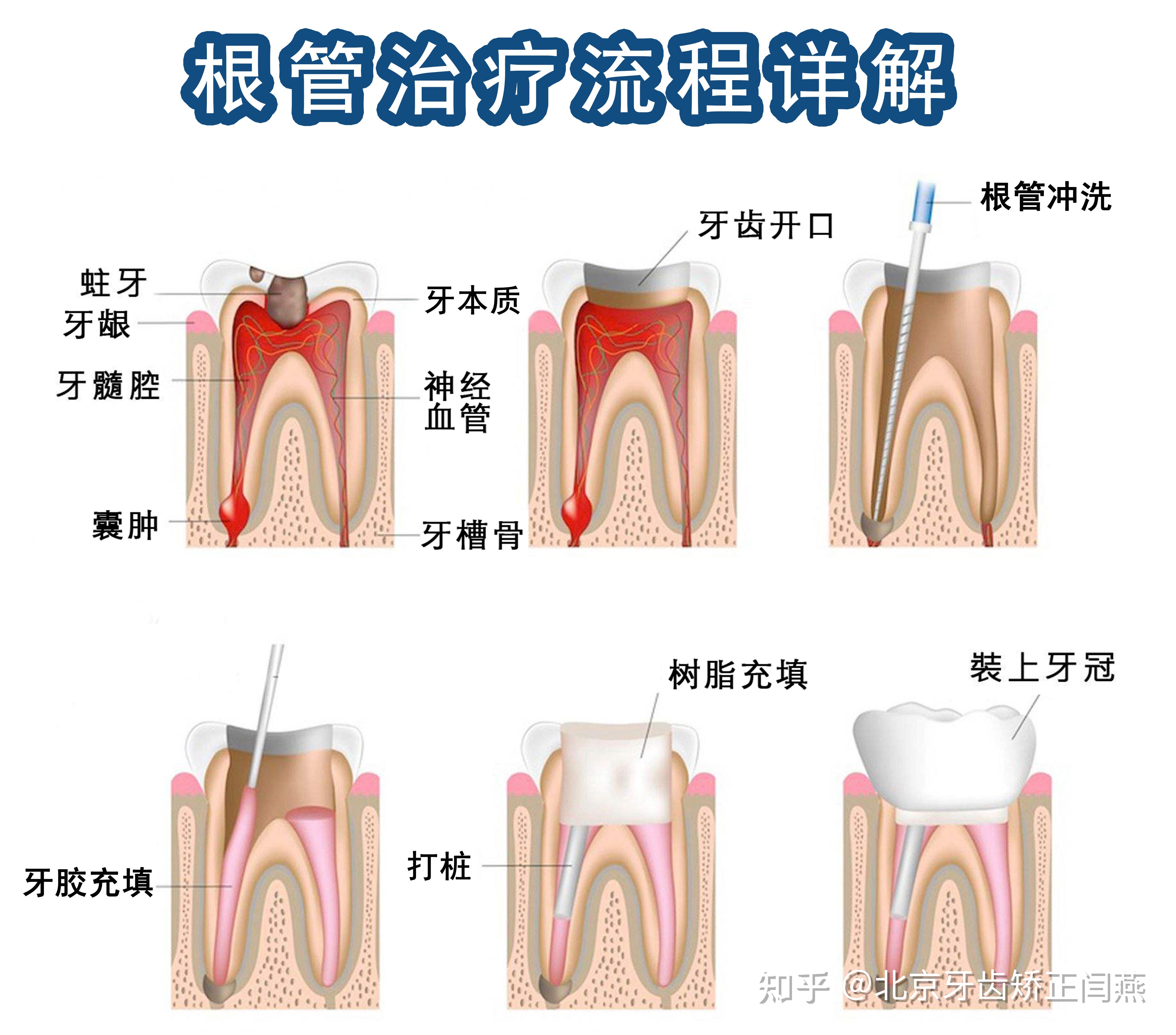 牙齿根管治疗图片步骤图片