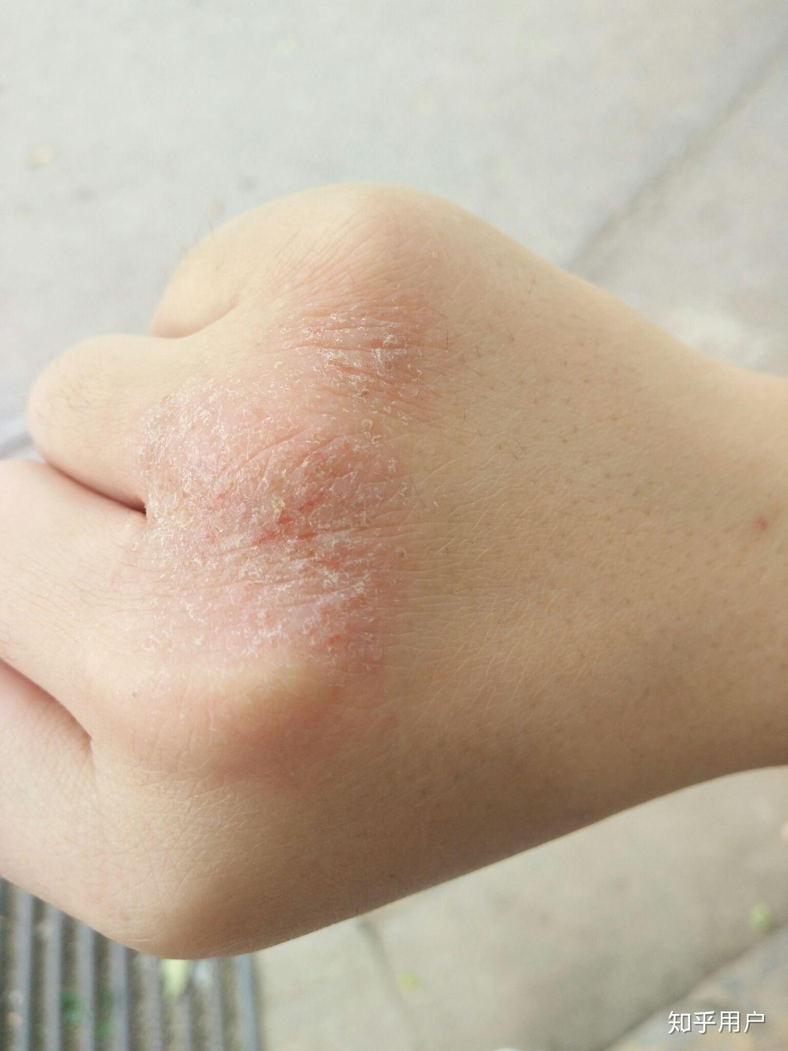 手部湿疹能根治吗