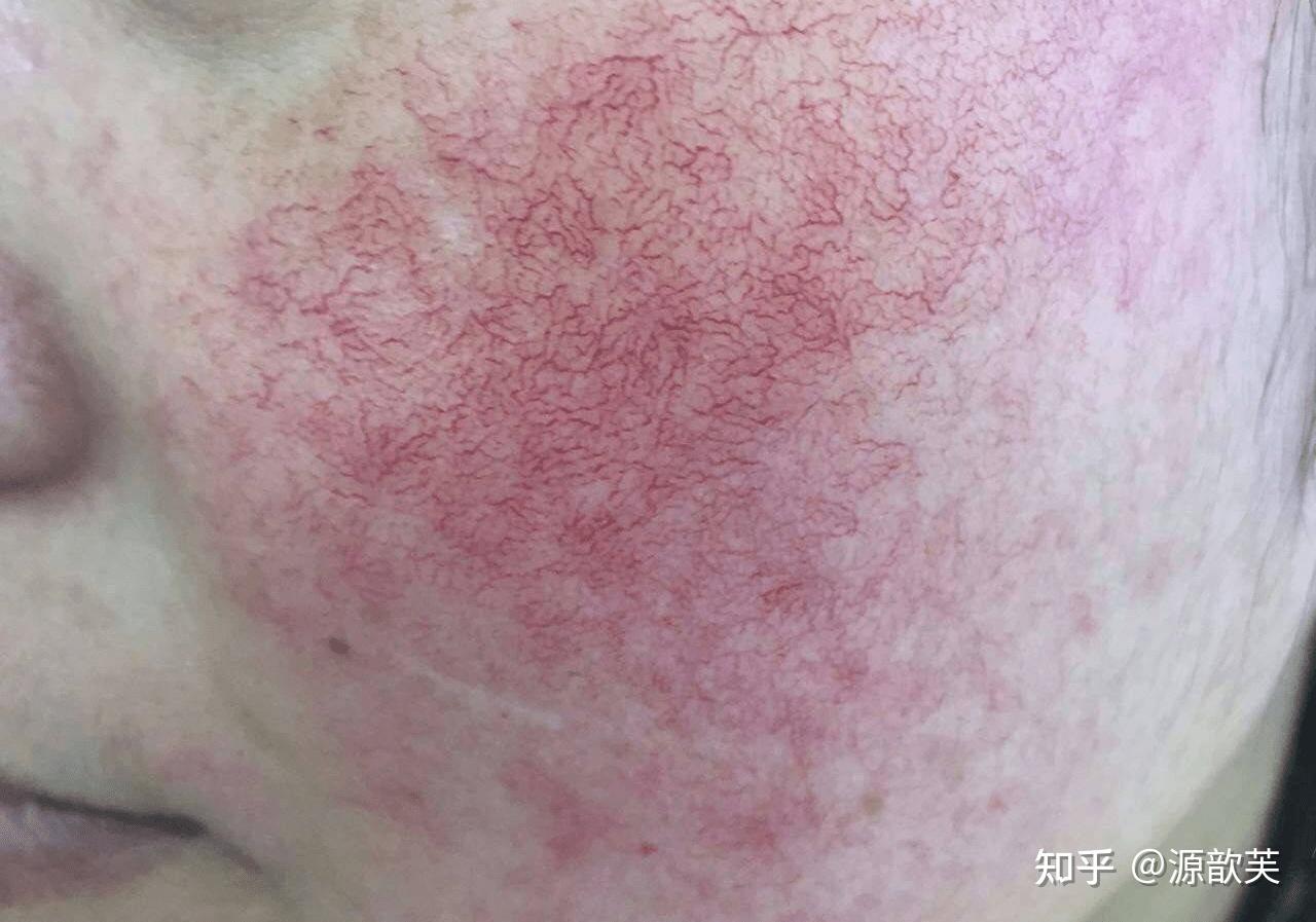 我的红血丝敏感肌该如何拯救