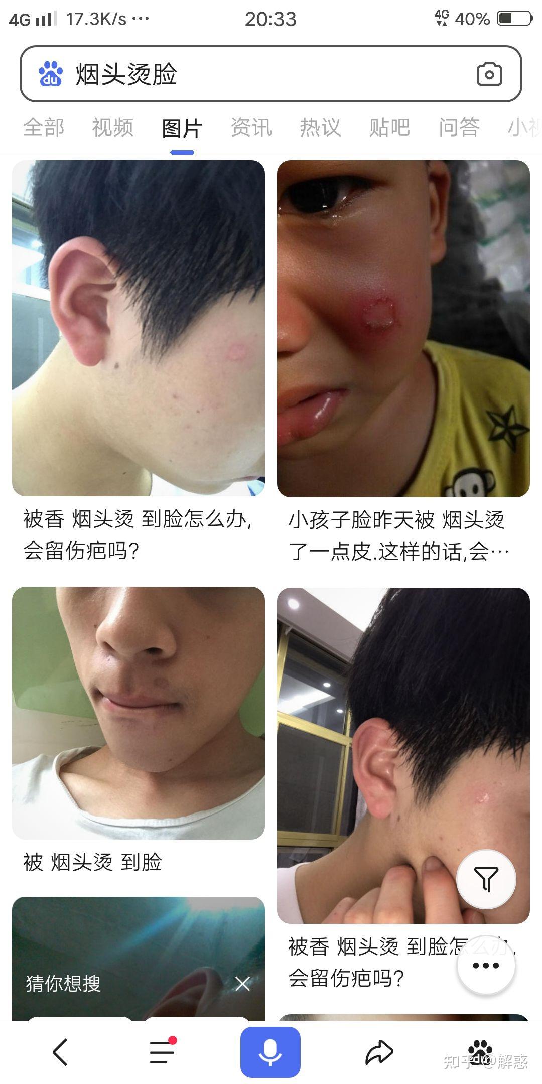 如何看待业绩不好被老总烟头烫脸伤者老总事后说酒后行为要求和解被拒