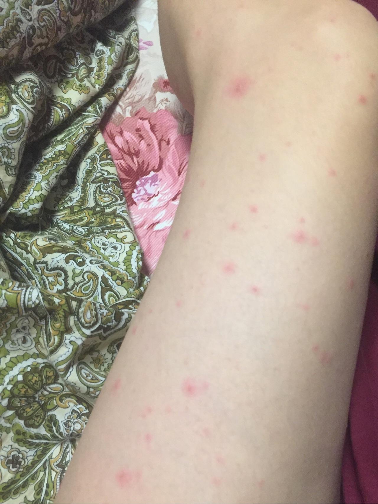 30多岁老阿姨的水痘日记