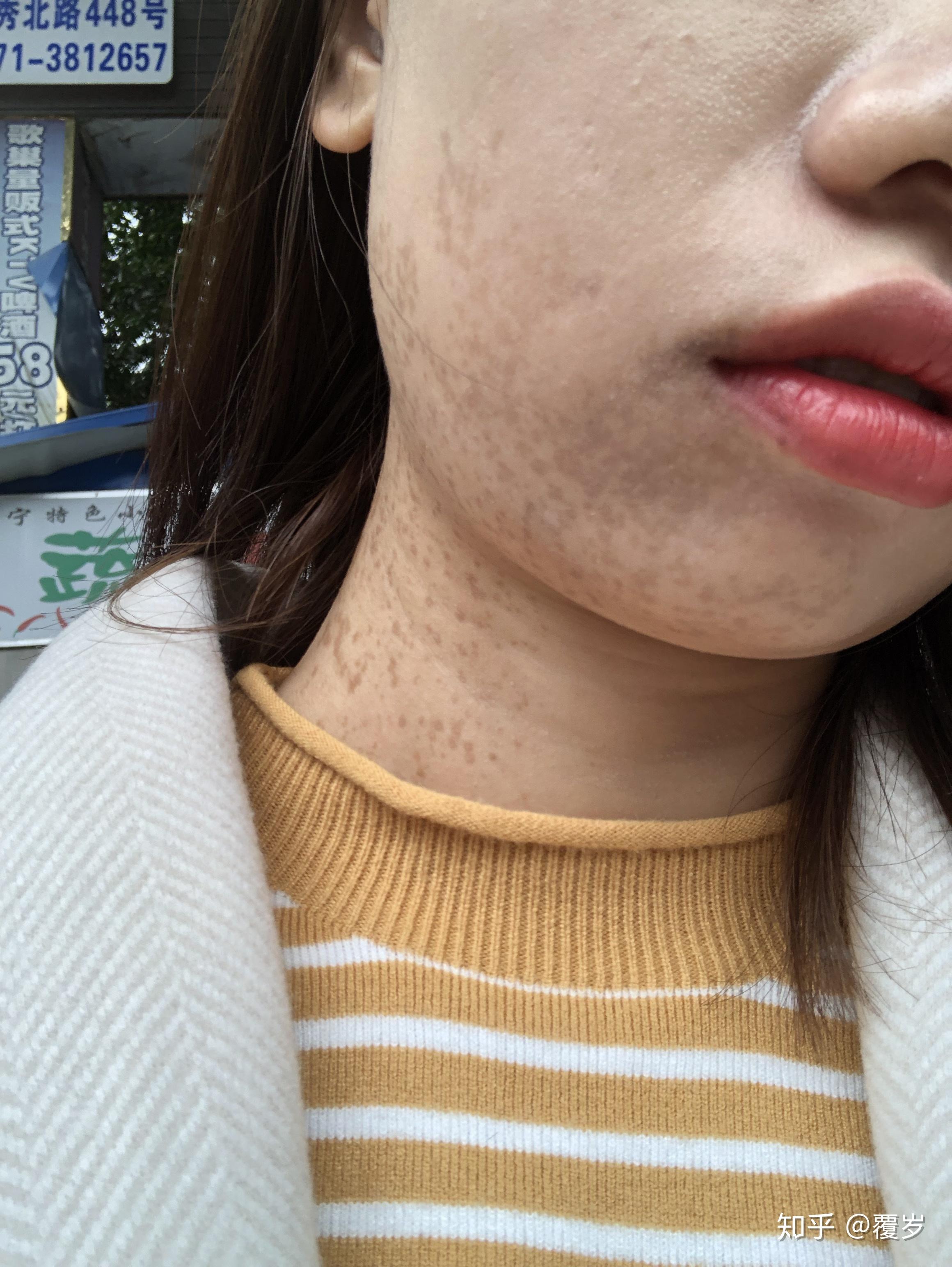 脸上有胎记是一种怎样的体验