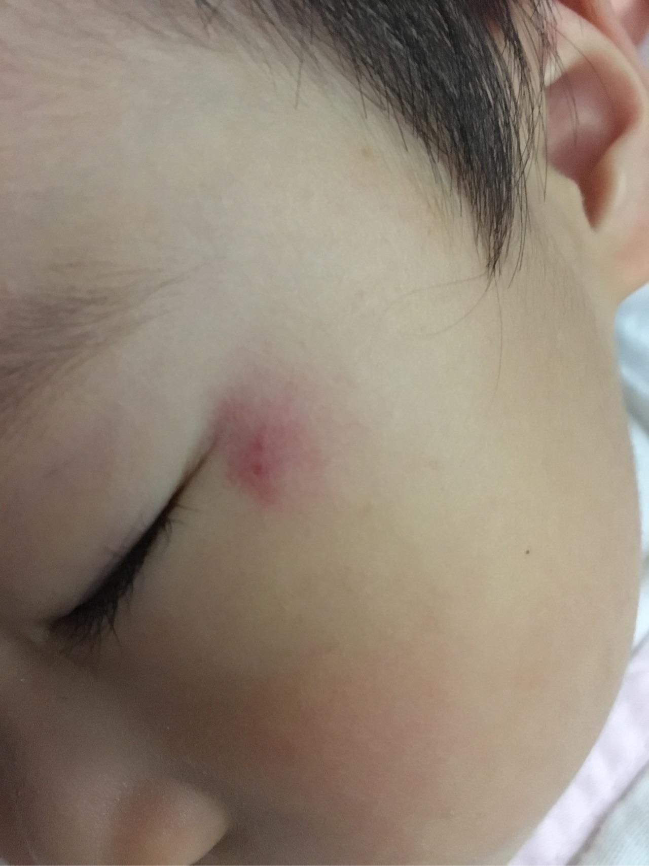 什么是血管瘤血管瘤照片